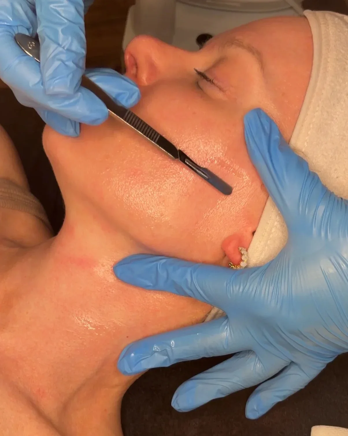 dermaplane pic 2